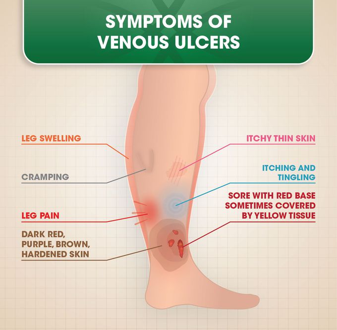 Symptoms of Venous leg ulcer