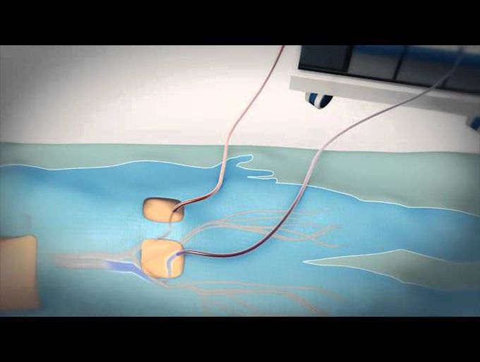 Minimally Invasive Robotic Mitral Valve
Repair - Made Easy