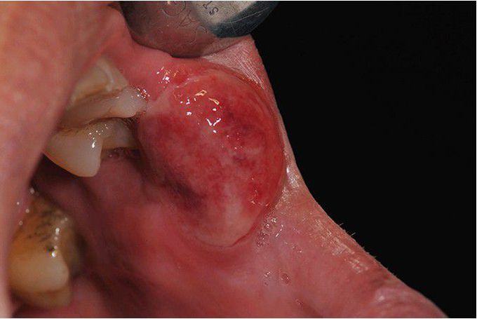 Chancre of Primary Syphilis