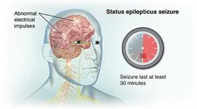 Medical Management of Status Epilepticus in ER