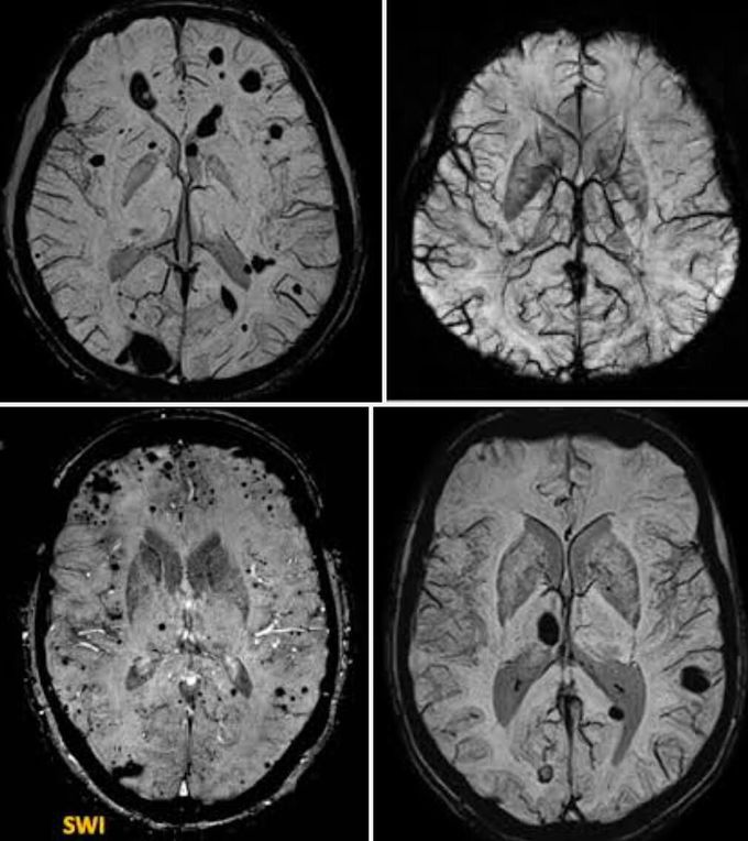 Susceptibility-weighted imaging (SWI)