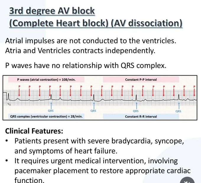 Heart Block VI