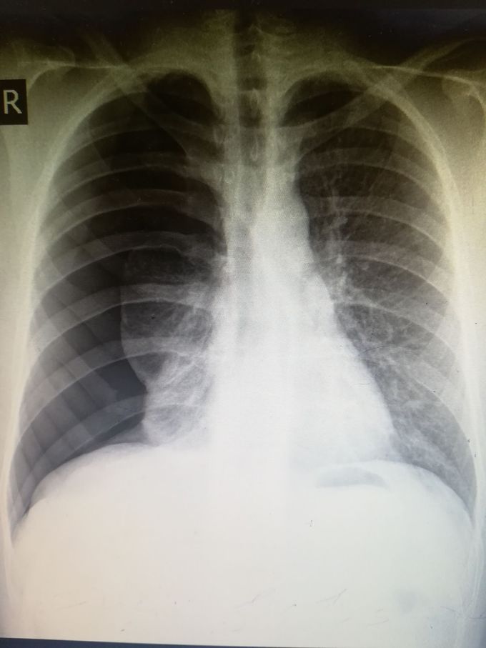 Sudden shortness of breath (chest xray) MEDizzy