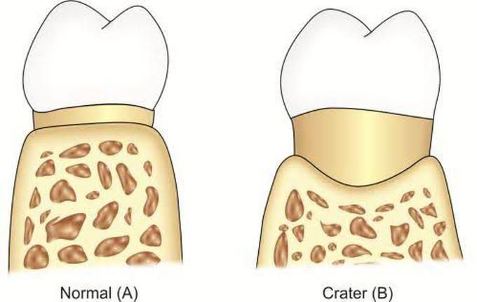 Osseous craters