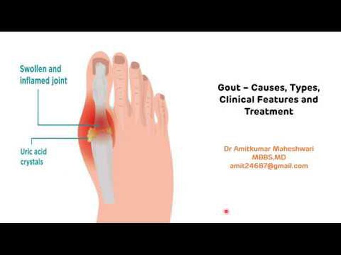 Hyperuricemia(Gout and associated disorders)