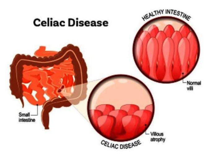 Celiac disease