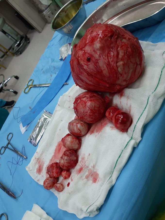 Myomas_Shariati Hospital_Tehran
