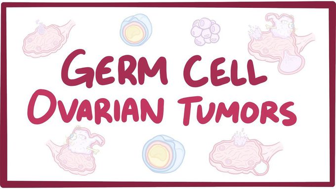 Germ cell ovarian tumors