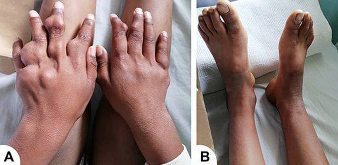 Ollier Disease