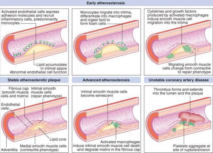 Atherosclerosis