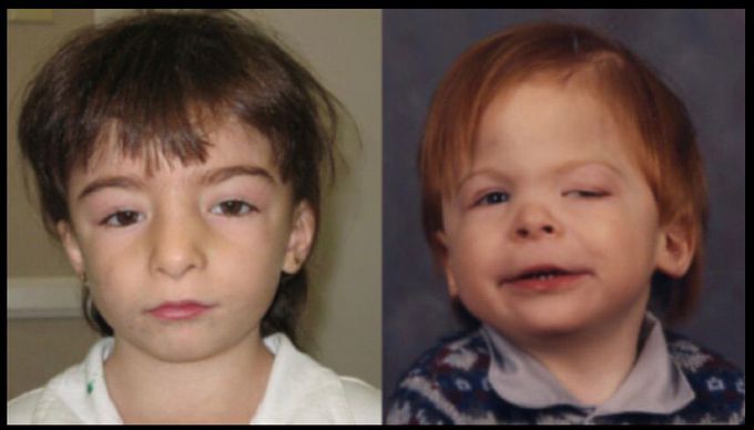 Define Ahumada-del Castillo syndrome?                         Unphysiologic lactation and amenorrhea not following pregnancy characterized by hyperprolactinemia and a pituitary adenoma.
