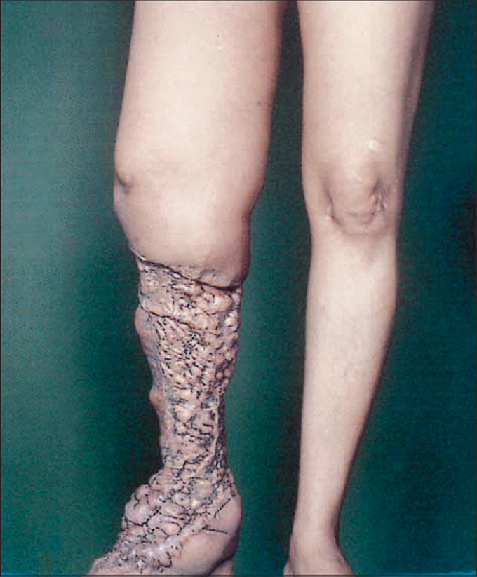 A complication of debulking surgery for lymphedema

