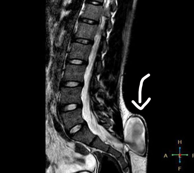 Spina Bifida (myelomeningocele)