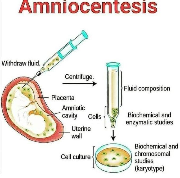 Amniocentesis