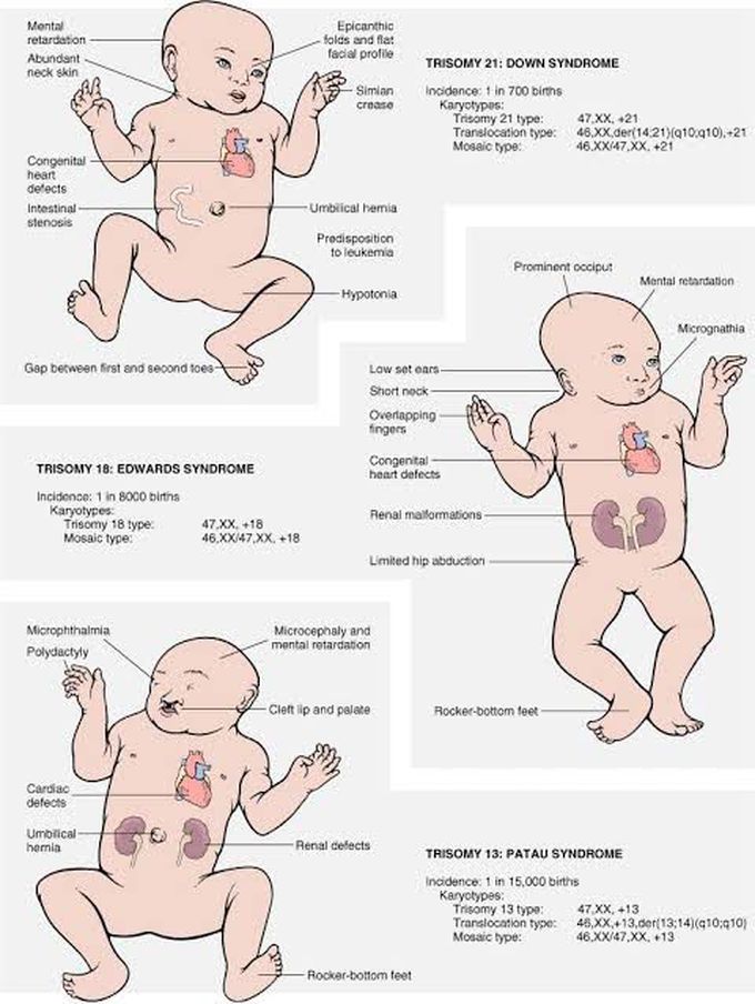 Genetic Disorder (Trisomi)