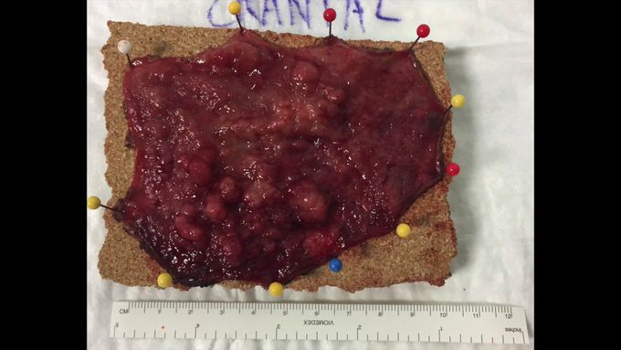Hybrid Transanal Resection of Near-Circumferential Large, Low Rectal Polyp