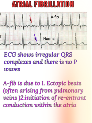 Atrial fibrillation - MEDizzy