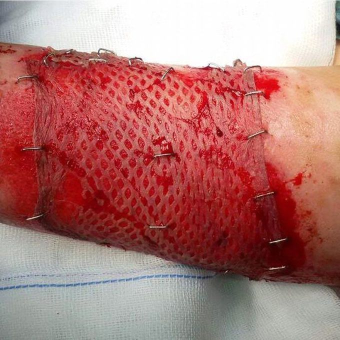 Skin transplant on a 9 year old boy after a second degree burn on his left upper arm