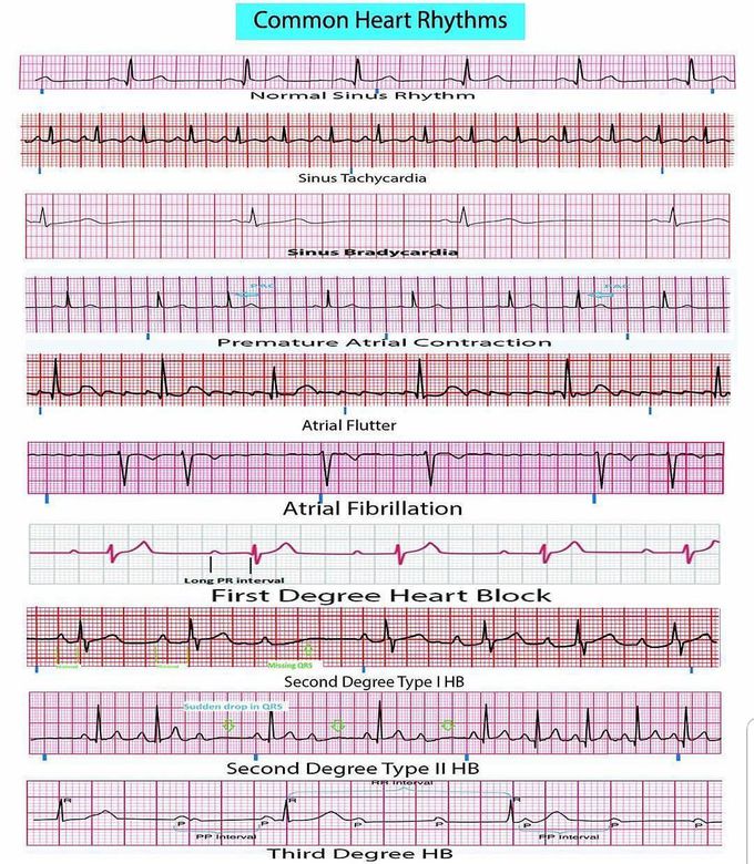 Common heart Rhythms MEDizzy