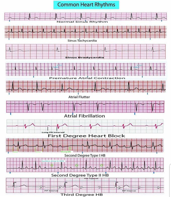 Common heart Rhythms