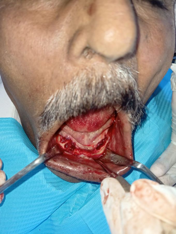 Alveoloplasty