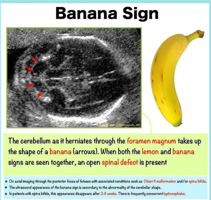 Banana sign