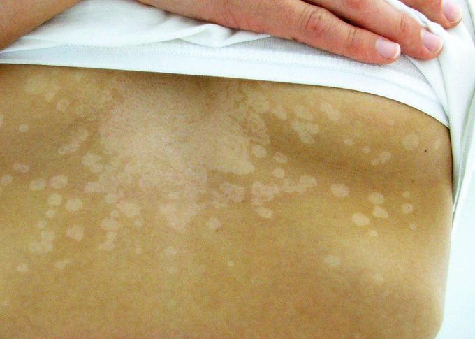 Tinea Versicolor AKA Pityriasis Versicolor