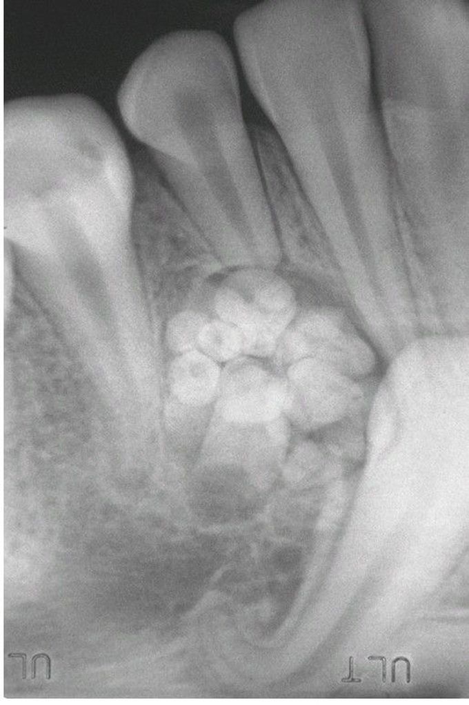 Compound Odontoma