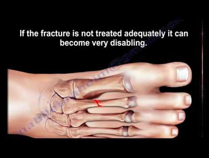 Stress Fractures Of The Metatarsal Bones - Everything You Need To Know - Dr. Nabil Ebraheim
