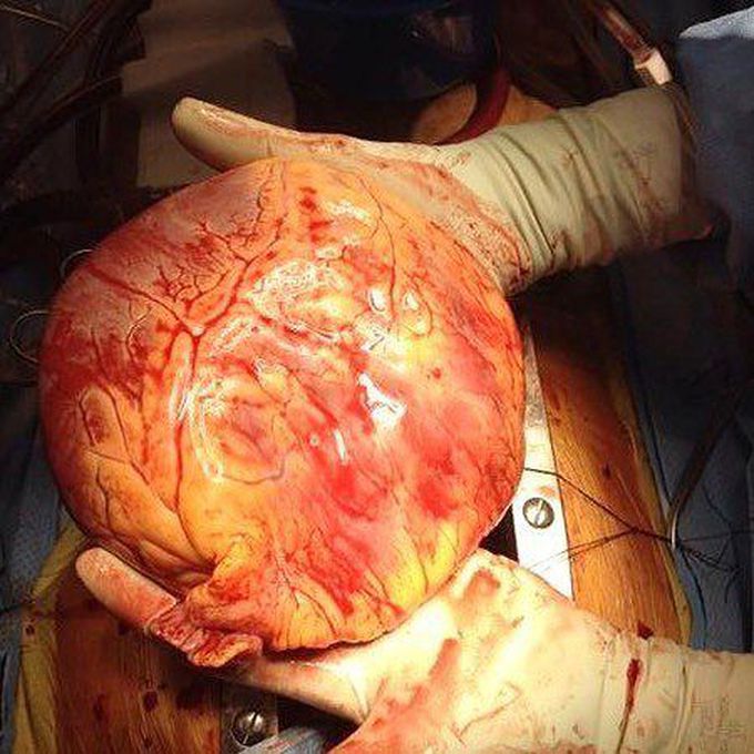 A case showing end-stage dilated cardiomyopathy.  