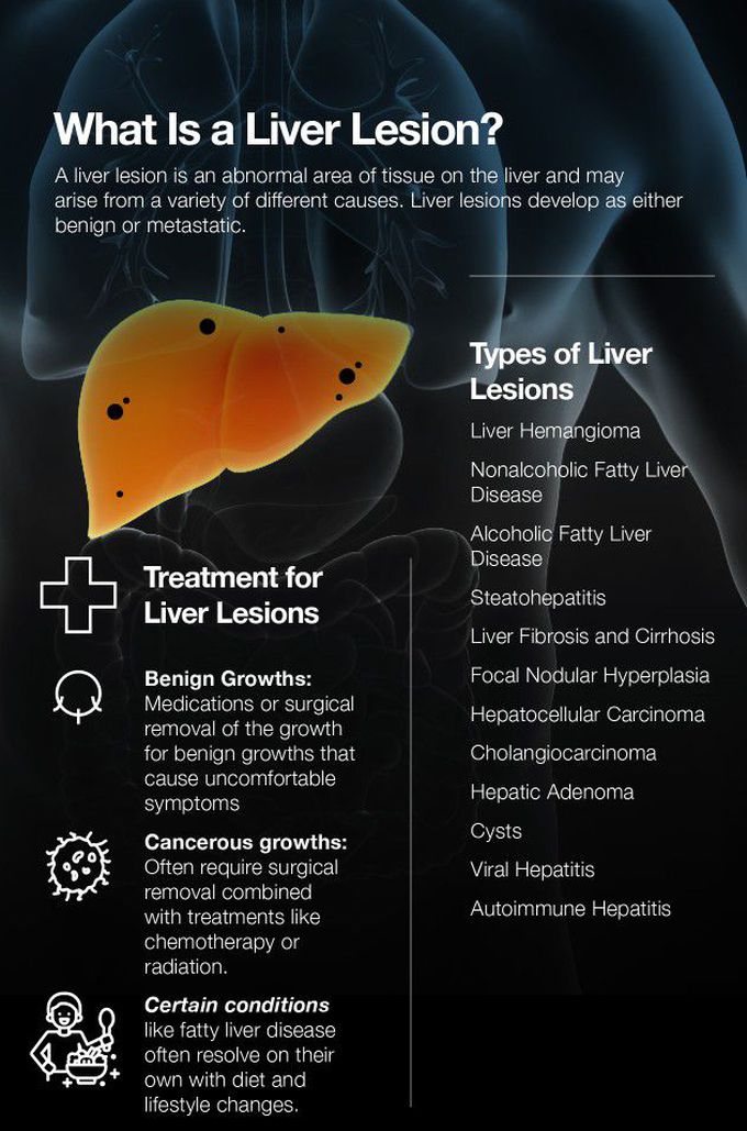 Treatment of Liver lesions
