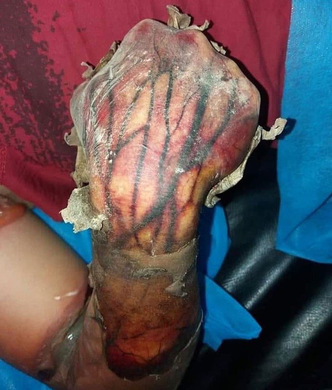 This is a third-degree burn, as the skin and underlying tissues are destroyed