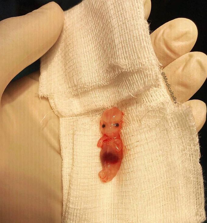 Approximately over 9 week old fetus extracted from an ectopic pregnancy! 
