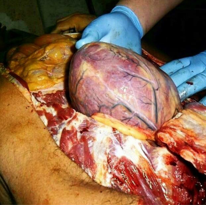 Cardiomegaly