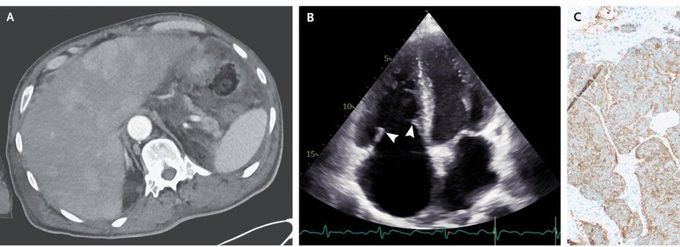 Carcinoid Heart Disease