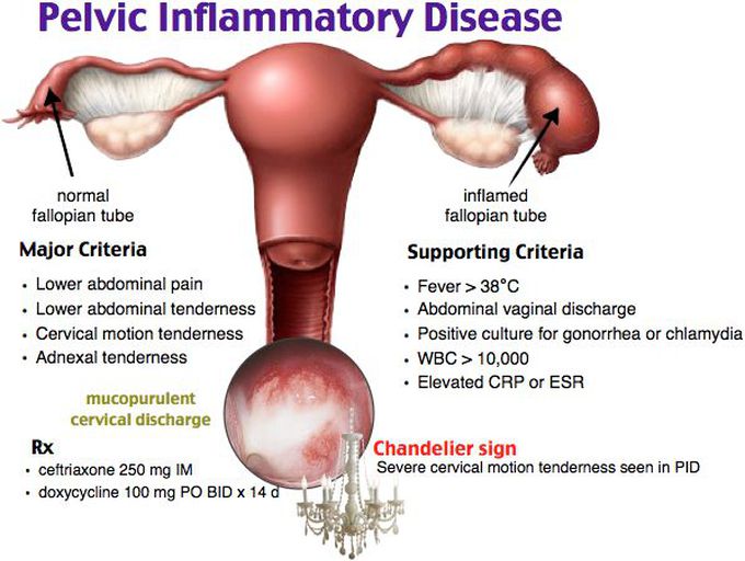 Pelvic inflammatory disease