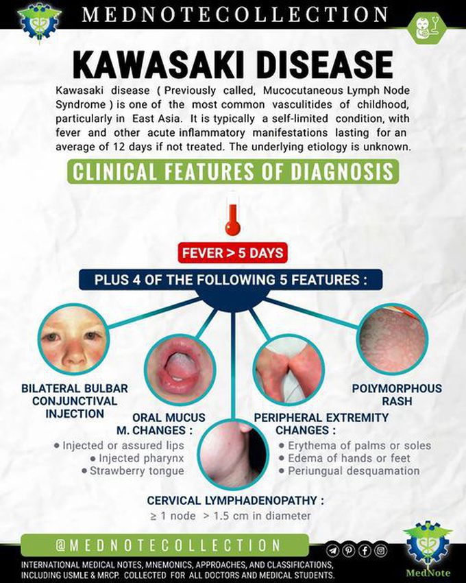 🧠 KAWASAKI DISEASE