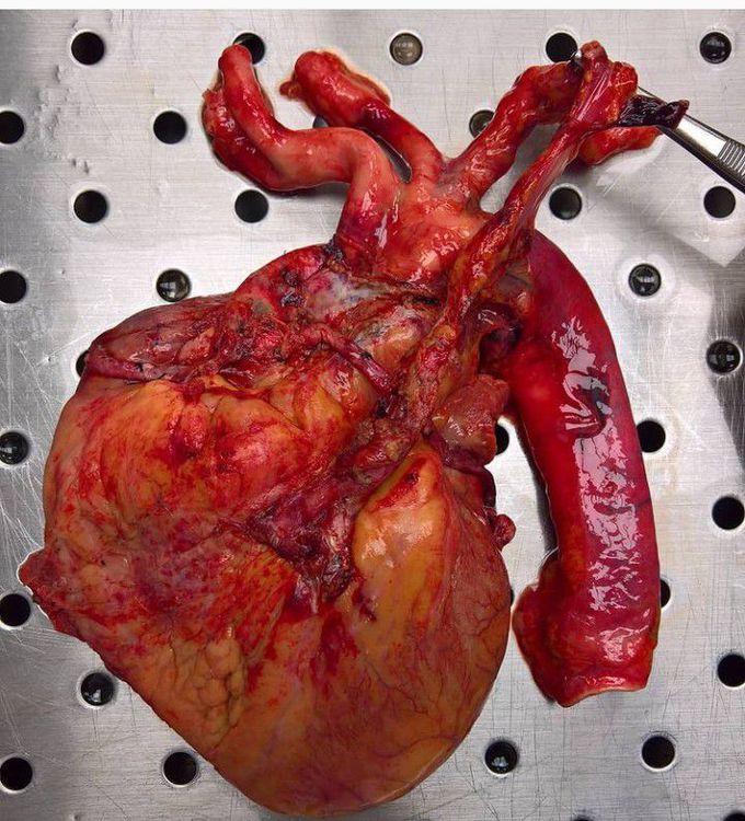 Internal Thoracic Artery (ITA)