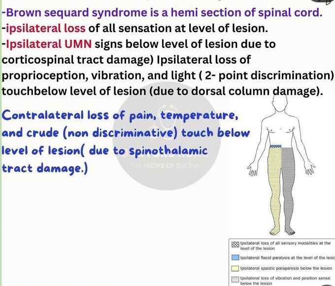 Brown Sequard Syndrome