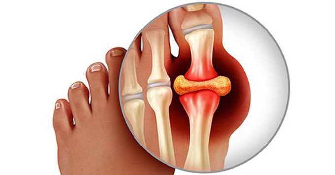 gouty arthritis symptoms