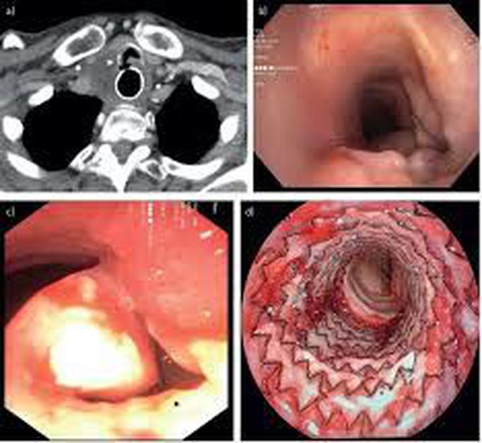 What causes tracheoesophageal fistula?