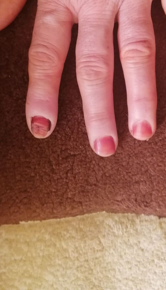 nail problem