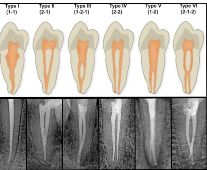 Vertucci Classification