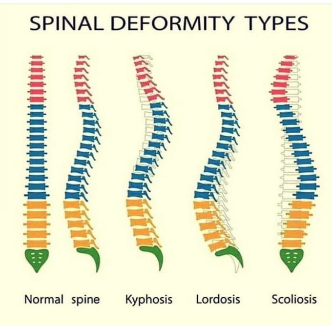 Spinal Deformities