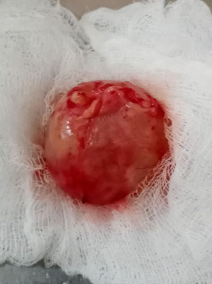 Mesenteric cyst