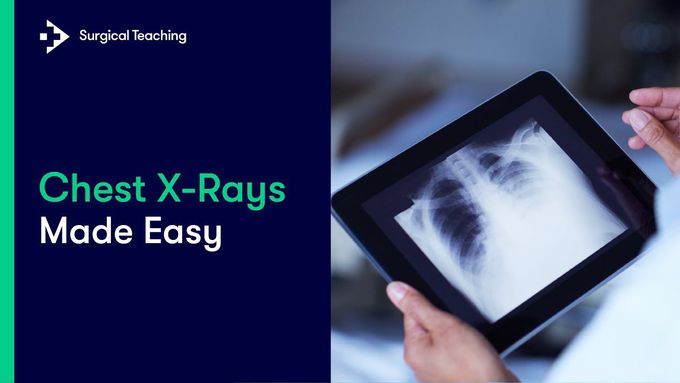 Chest X-Rays Made Easy