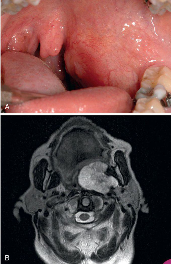 Pleomorphic Adenoma