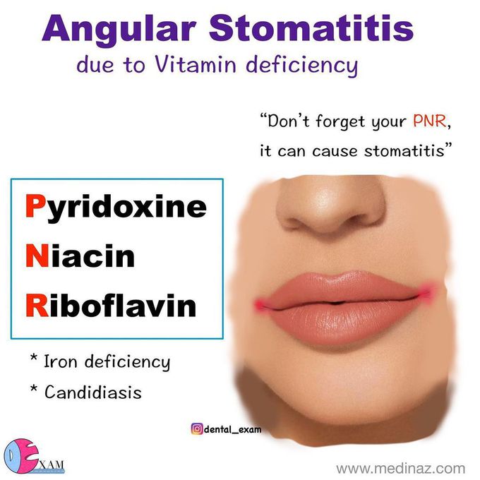 Drugs for angular Stomatitis