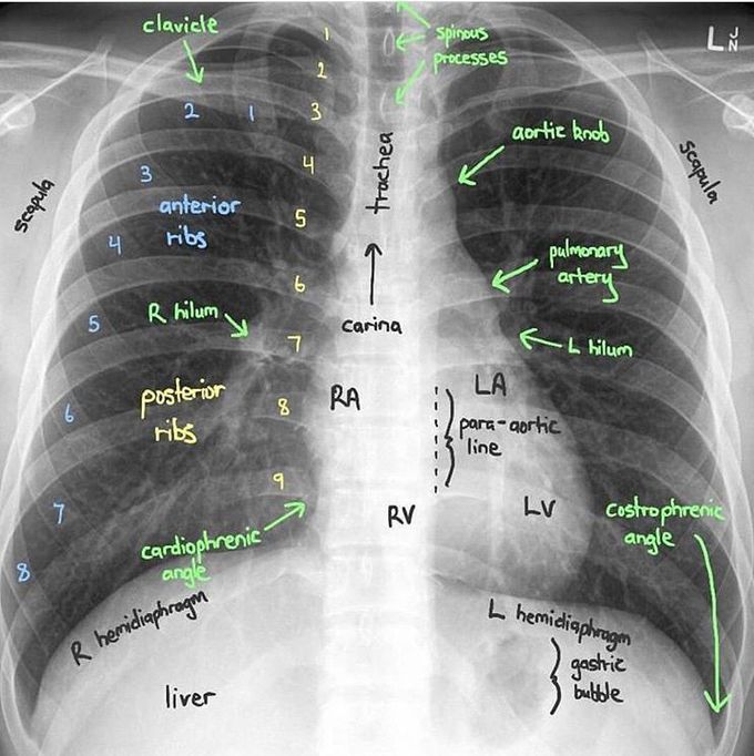 X-ray of chest