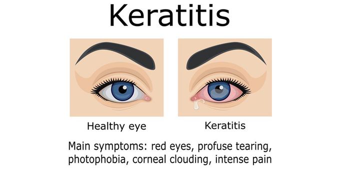 Keratitis